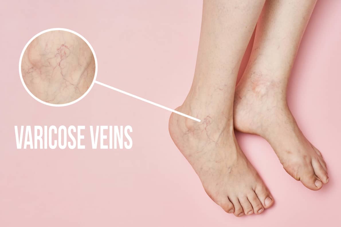 Autophagy varicose Veins
