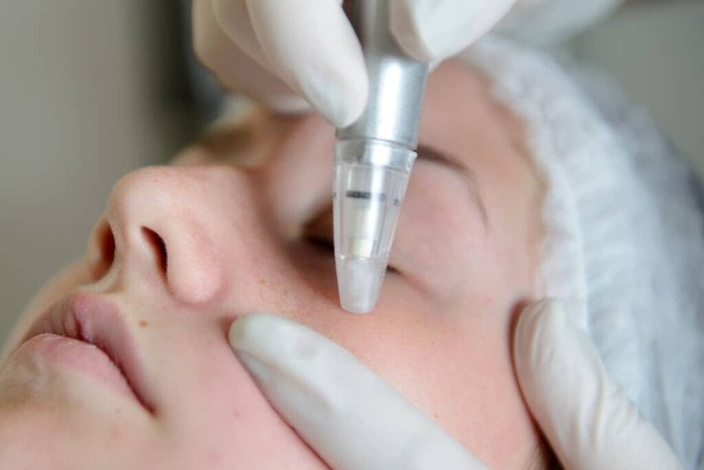 microneedling for different face color than body
