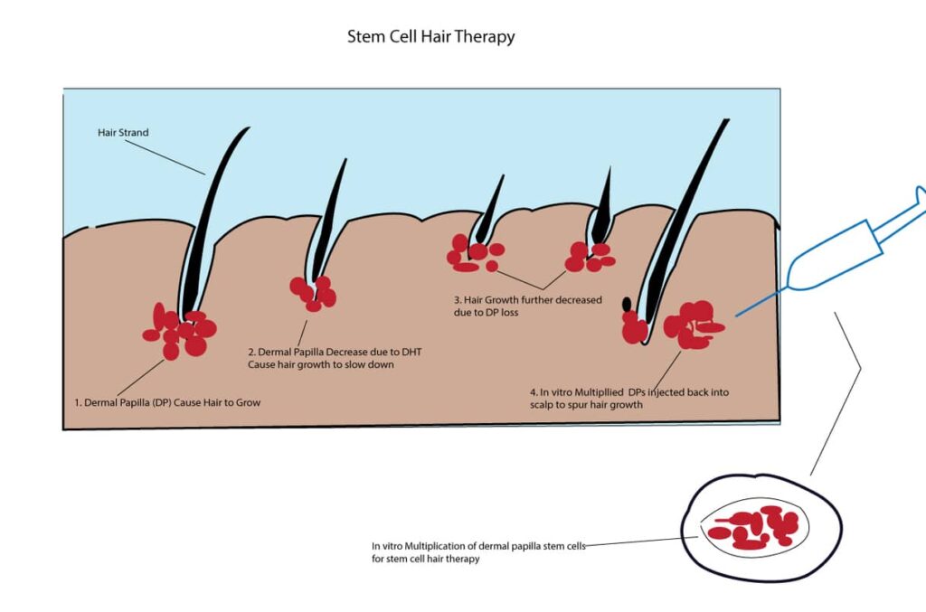 Hair Stem Cell Therapy for Pattern Baldness