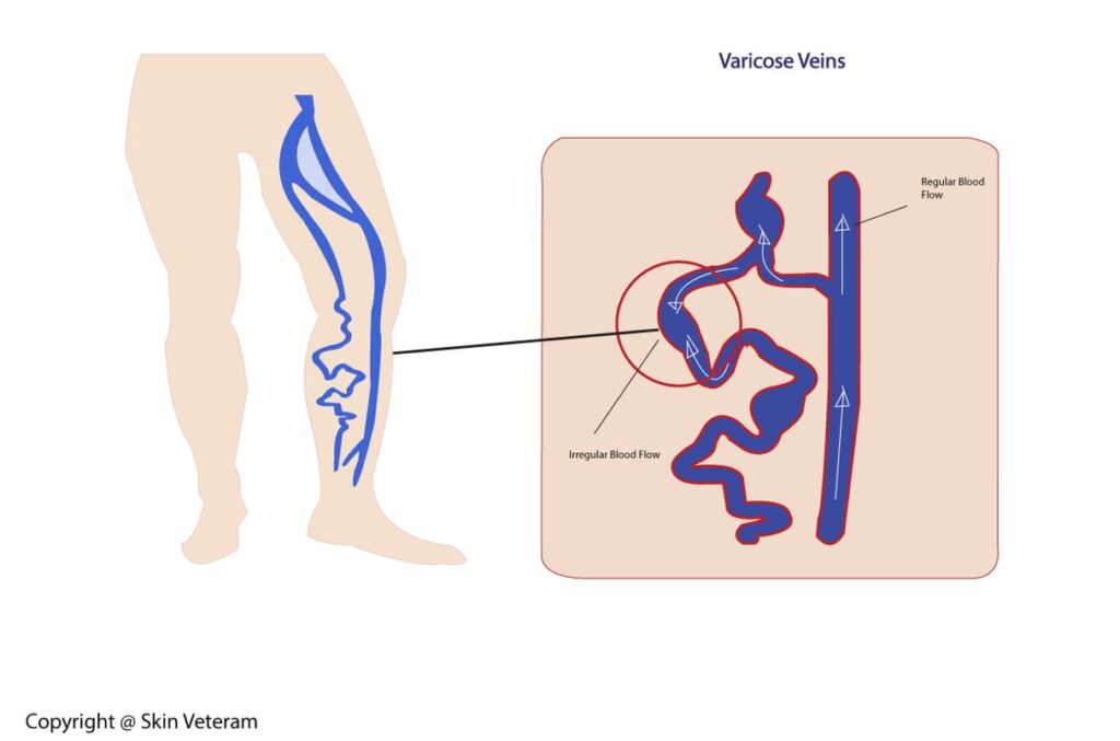 Varicose Veins, Spider Veins