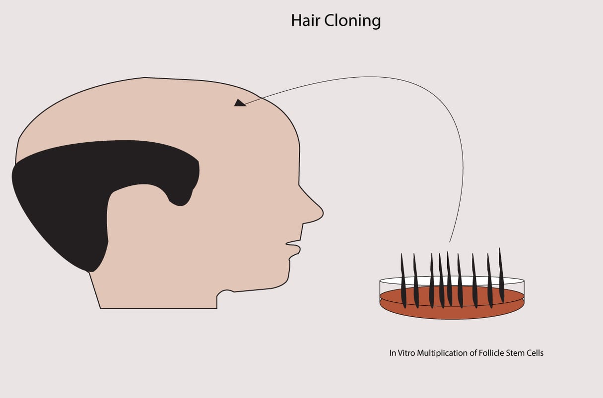 Will Baldness Be Cured By 2025? (Advances In Hair Cloning)