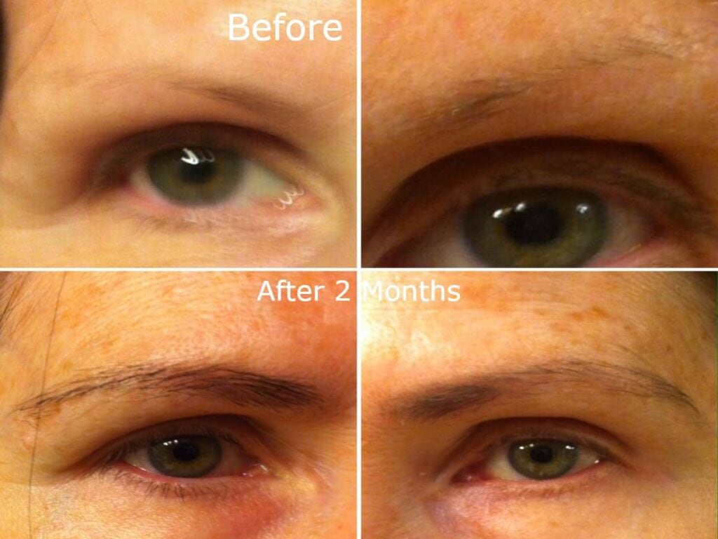 rogaine for eyebrows before and after